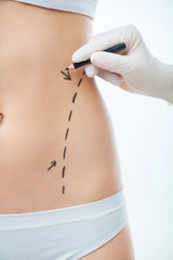 Plastic surgeon drawing lines on body of a girl 