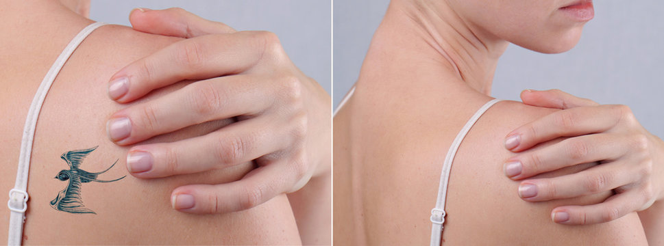 Laser tattoo removal befor and after. Beautiful young woman with