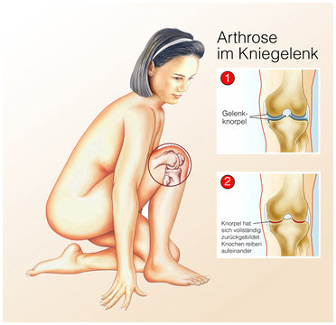 Arthrose im Kniegelenk. Knorpelschaden
