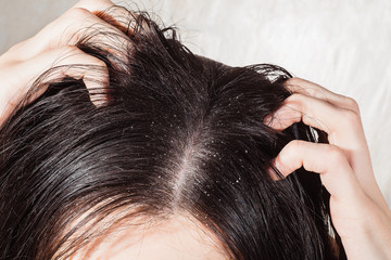 Dander that causes itching scalp - obrazy, fototapety, plakaty