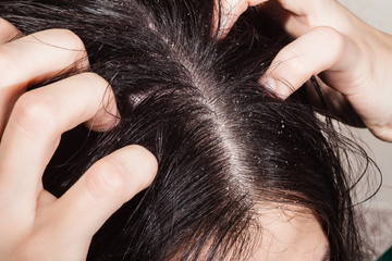 Dander that causes itching scalp - obrazy, fototapety, plakaty