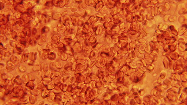 Human Blood Cells Seen Clumping at 800x Phase Microscope