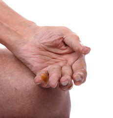 Man with a diagnosis of polyarthritis .