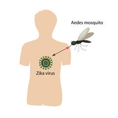 Zika virus. Mosquito bite. Infographics. Vector illustration