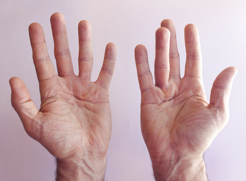 Hands of an man with Dupuytren contracture disease  against  bright background