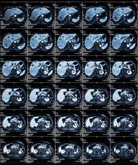 MRI of the Abdomen organs