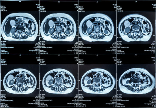MRI of the Abdomen organs