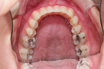 Z&auml;hne mit F&uuml;llung 