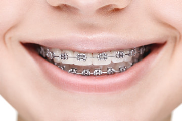 Broad smile girl with metal braces. Closeup