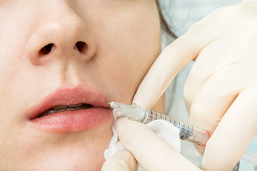 Professional cosmetic procedure is the increase in the upper lips with hyaluronic acid injections.real operation