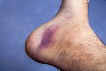 Bruised ankle after tripping over and twisting on right hairy foot on blue background.
