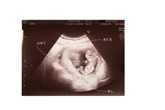 妊娠１１週目の赤ちゃんのエコー写真