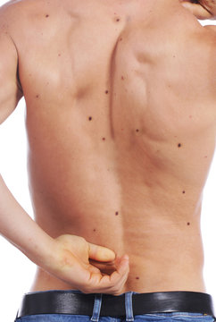 Junger Mann mit dunklen Muttermalen, Hautkrebs