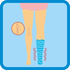 illustration legs with vascular net legs with edema. adverse pregnancy symptoms