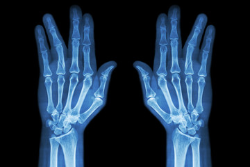 Fracture shaft of proximal phalange of ring finger ( film x-ray both hand AP )