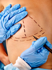 Breast cancer surgery. Doctor hands wearing gloves makes dotted line on female body.