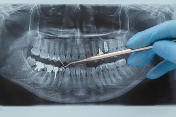 Dental X-ray. Radiography on white background