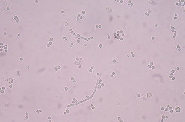 budding yeast cells with pseudohyphae in urine sample.