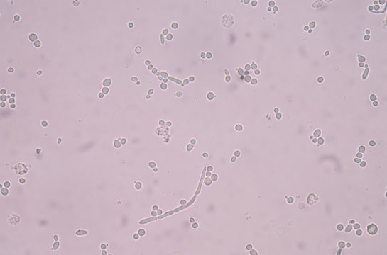 Budding Yeast Cells With Pseudohyphae In Urine Sample.