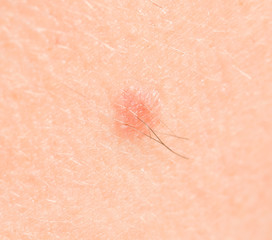Fototapeta premium mole on the skin
