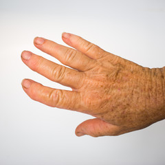 An older  Lady' s hand with swollen joints and a distorted finger caused by arthritis