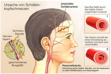 Gefäß-Rheuma.Schläfenkopfschmerzen