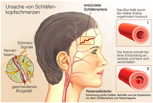 Gef&auml;&szlig;-Rheuma.Schl&auml;fenkopfschmerzen