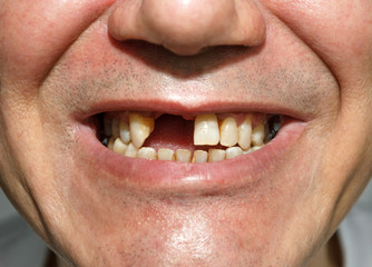 Fototapeta premium Smile without teeth