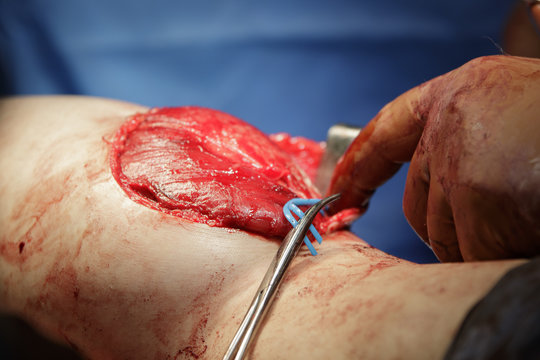 Calf Muscle Surgery.
Leg surgery details with open wound, uncovered muscle and Kocher's clamp holding wire.