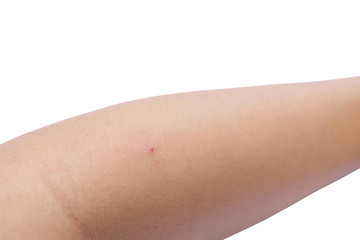 small lesion with blood on skin at arm (Isolated and have clippi