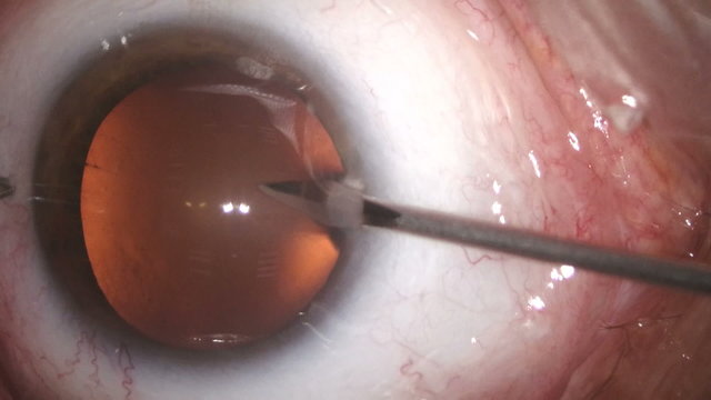 Close-up view of cataract removal surgery from human eyeball