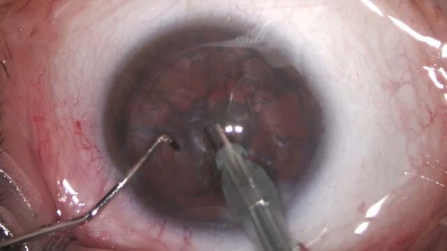 Close-up view of cataract removal surgery from human eyeball