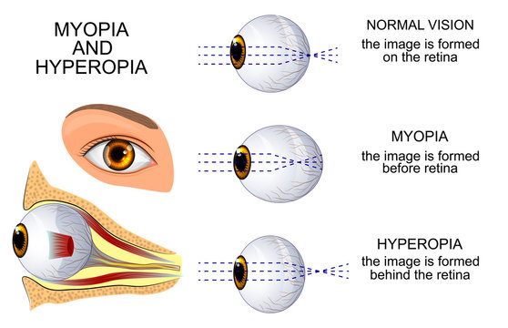 képek a myopia hyperopiaról a legjobb gyógyszer a látáshoz