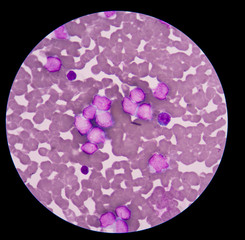 Myeloblasts showing in blood smear.