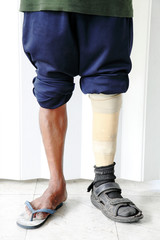 Amputee wearing a prosthetic leg standing, close up view of their leg and the prosthesis