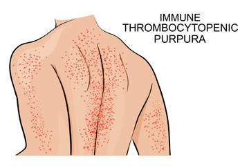 the skin lesions in immune thrombocytopenic purpura