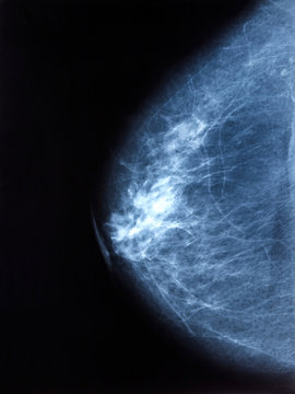 X-ray image of breast mammogram woman