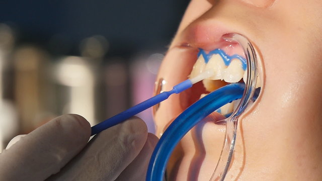 Whitening teeth closeup in slow motion