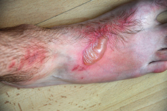 Phytophotodermatitis, cutaneous phototoxic skin inflammatory eru