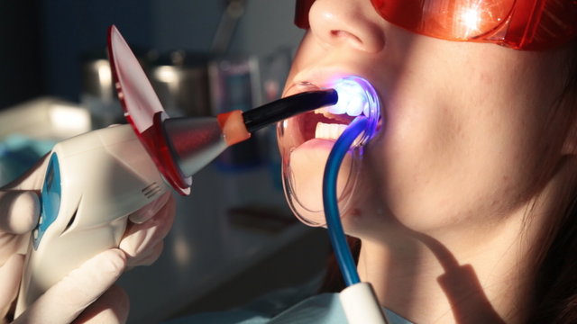 Dentist working with dental polymerization lamp in oral cavity.