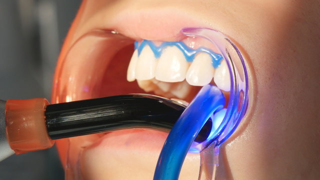 Dentist working with dental polymerization lamp in oral cavity.