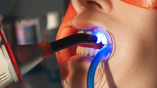 Dentist working with dental polymerization lamp in oral cavity.