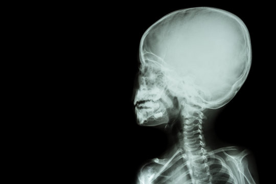 film x-ray skull and body of child ( blank area at left side )
