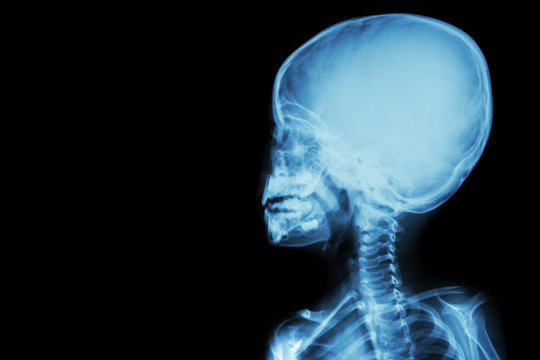 film x-ray skull and body of child ( blank area at left side )