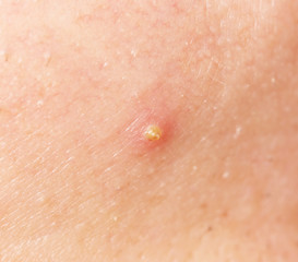 Fototapeta premium Acne skin