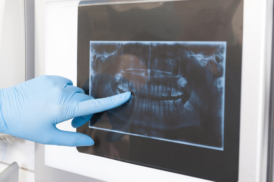 Close-up of dentist showing x-ray to a patient