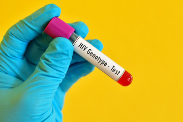 Obraz premium Test tube with blood sample for HIV genotype test 