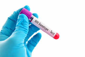 Obraz premium Test tube with blood sample for HIV genotype test 