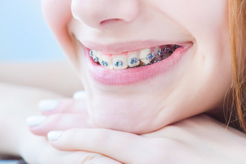 Obrazy na Plexi  Zęby z aparatami ortodontycznymi.