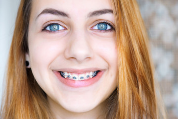 Teeth with braces.